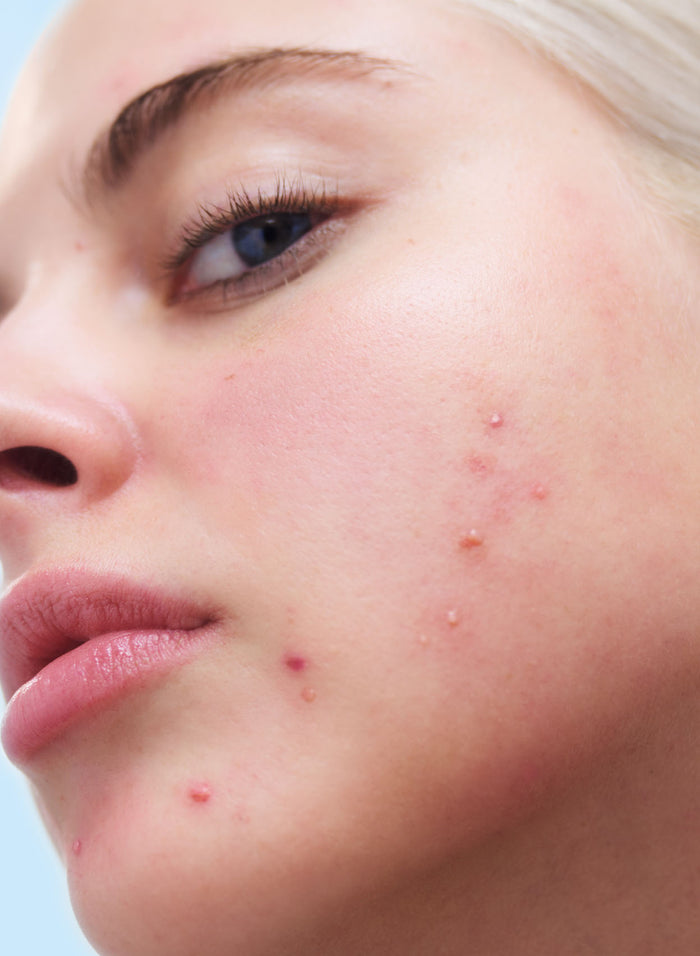 Acne Clarifying Cleanser