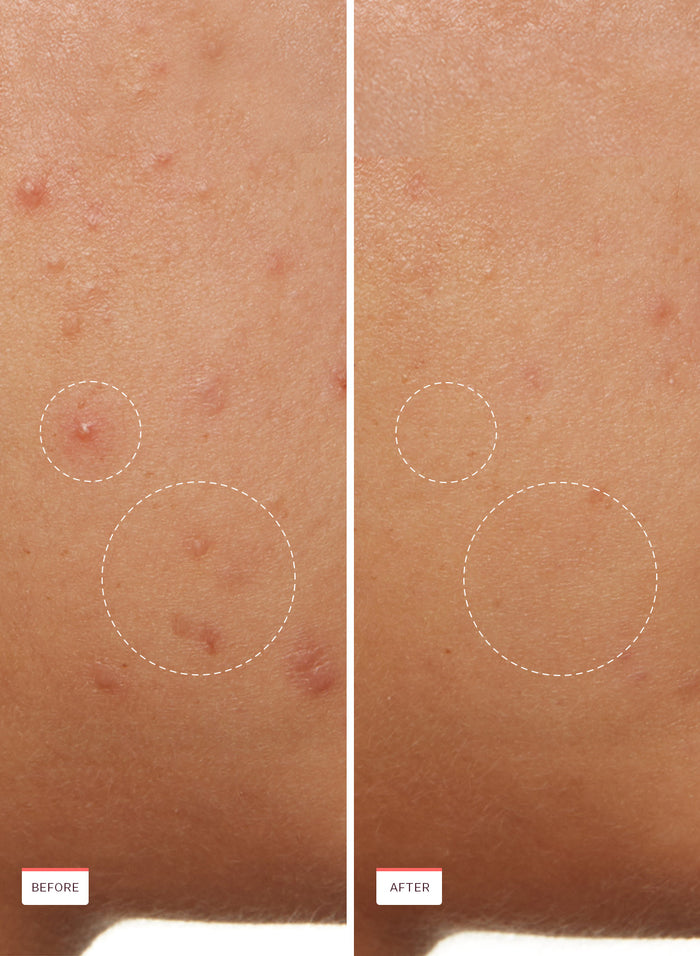 Acne Clarifying Cleanser