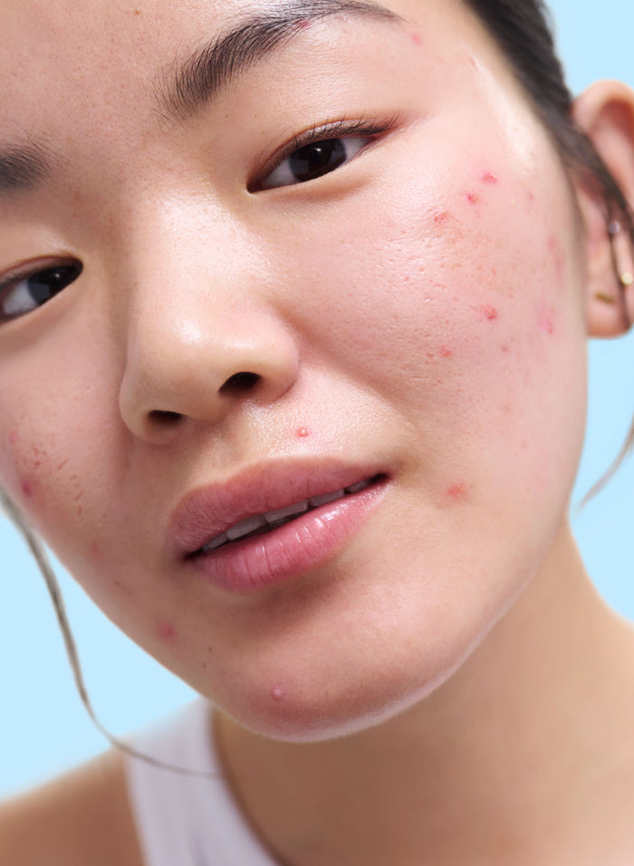 Acne Exfoliating Toner