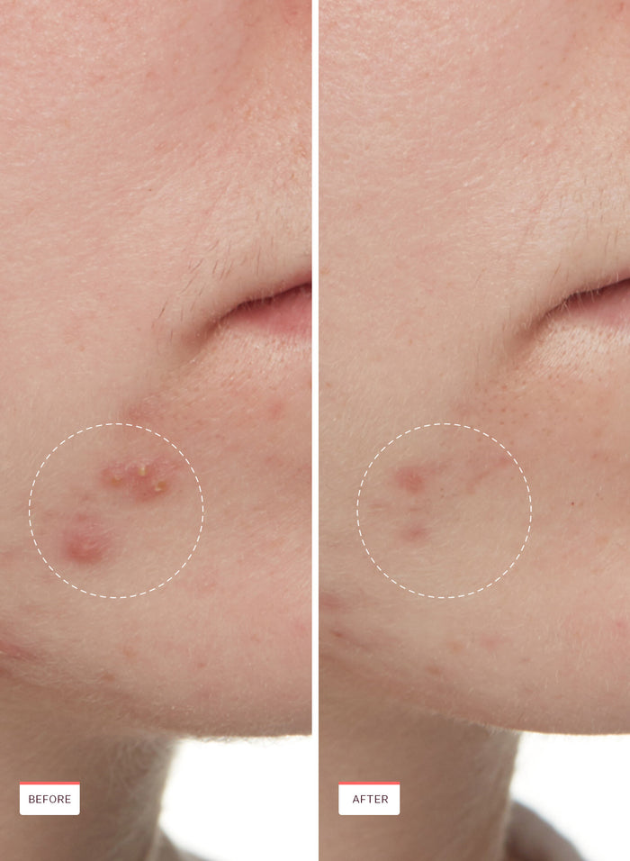 Acne Exfoliating Toner