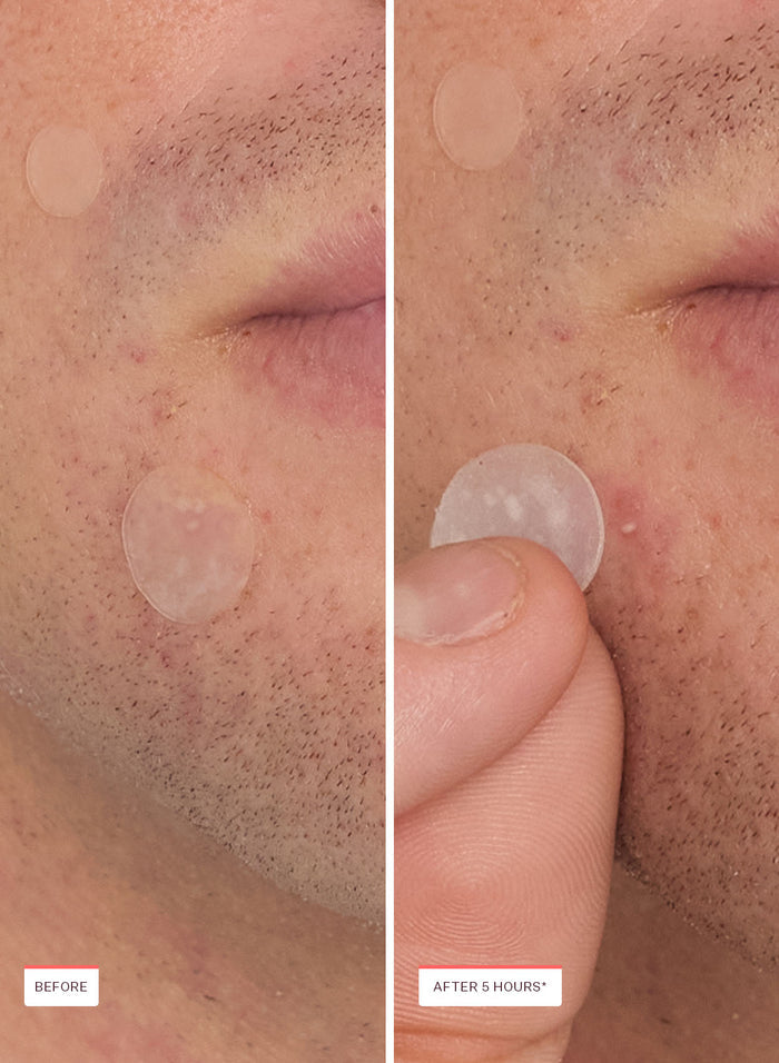 Acne Spot Treatment Trio