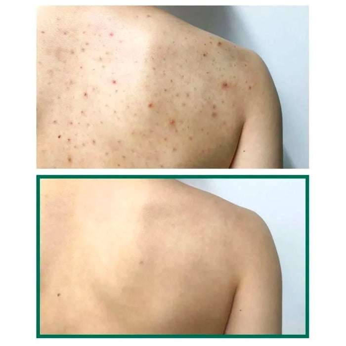 SOME BY MI AHA BHA PHA 30 Days Miracle Acne Clear Body Cleanser Nudie Glow Australia