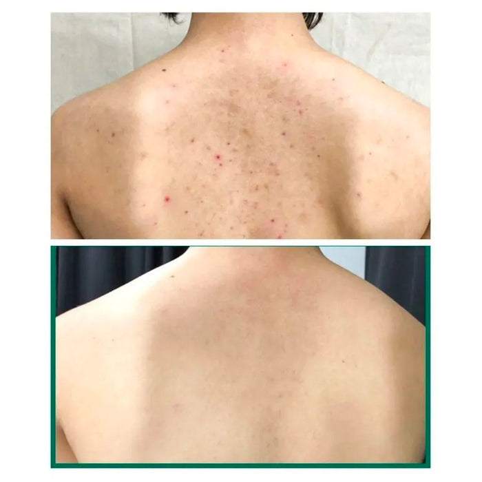 SOME BY MI AHA BHA PHA 30 Days Miracle Acne Clear Body Cleanser Nudie Glow Australia