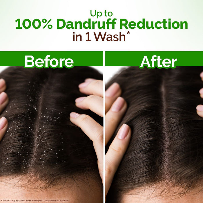 Mamaearth dandruff before after results showing scalp improvement
