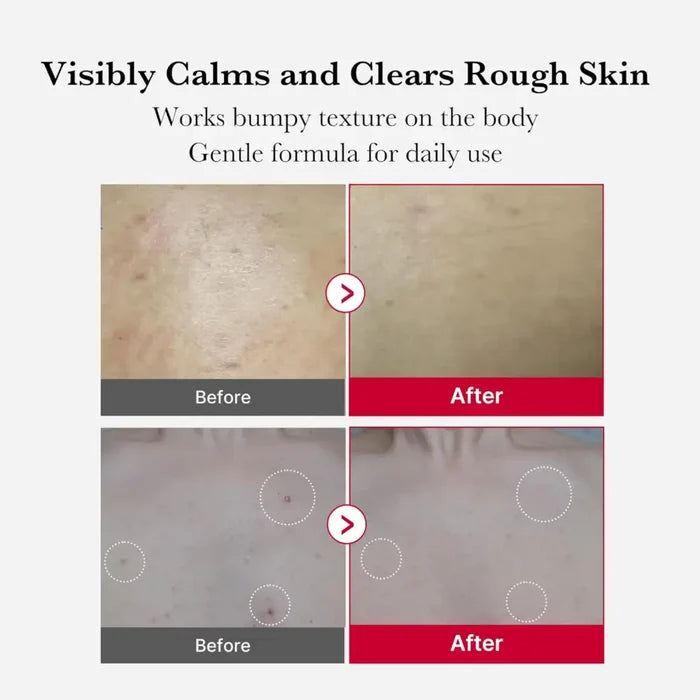 Red Acne Body Peeling Shot 110g - Care Medicube Wash