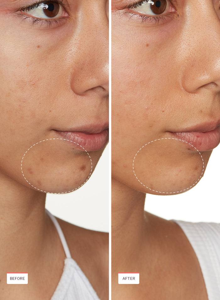 Transparen-C Pro Spot Treatment